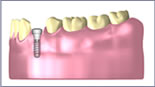 Einzelzahnimplantat Einheilschraube Seite unten